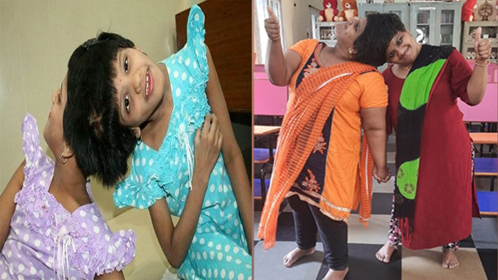 కష్టాలను జయించి.. డిగ్రీ పూర్తి చేసిన అవిభక్త కవలలు