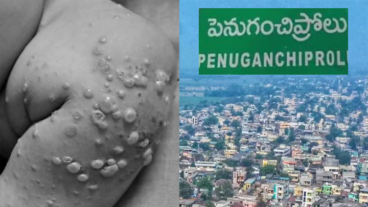 పెనుగంచిప్రోలులో వింత వైరస్.. చిన్నారులకు బొబ్బలు